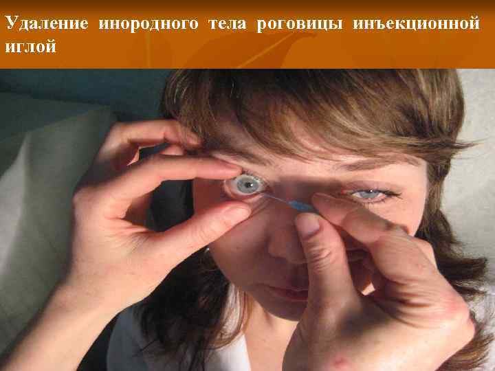 Удаление инородного тела роговицы инъекционной иглой 