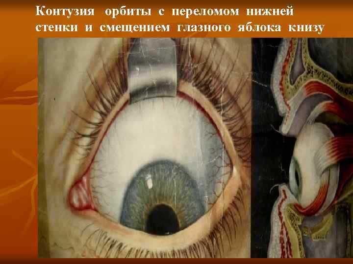 Контузия орбиты с переломом нижней стенки и смещением глазного яблока книзу 