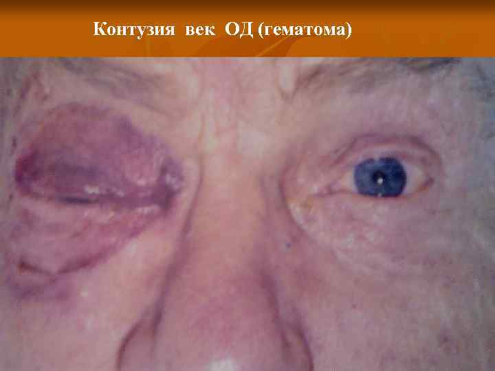 Контузия век ОД (гематома) 