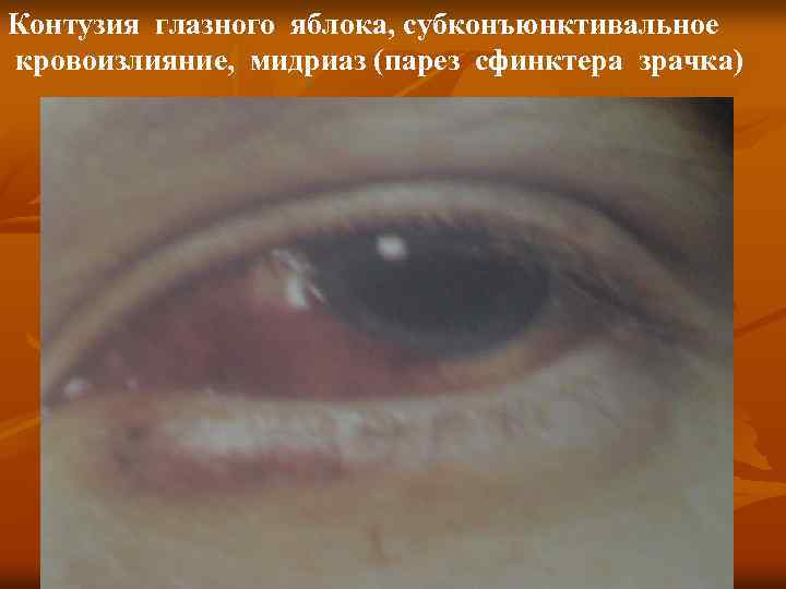 Контузия глазного яблока, субконъюнктивальное кровоизлияние, мидриаз (парез сфинктера зрачка) 