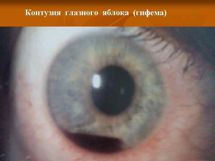 Контузия глазного яблока (гифема) 