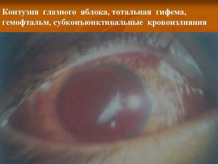 Контузия глазного яблока, тотальная гифема, гемофтальм, субконъюнктивальные кровоизлияния 