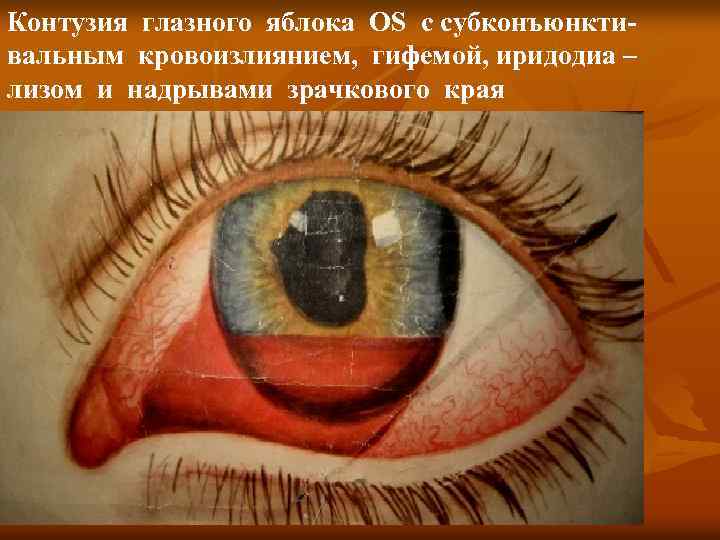 Контузия глазного яблока OS с субконъюнктивальным кровоизлиянием, гифемой, иридодиа – лизом и надрывами зрачкового