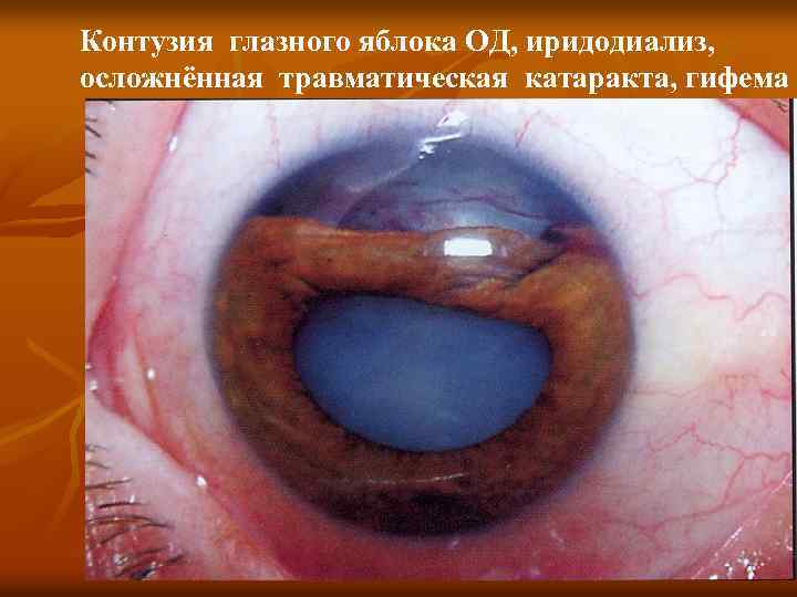 Контузия глазного яблока ОД, иридодиализ, осложнённая травматическая катаракта, гифема 