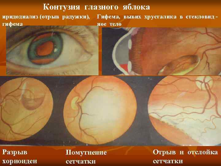 Контузия глазного яблока иридодиализ (отрыв радужки), гифема Разрыв хориоидеи Гифема, вывих хрусталика в стекловид