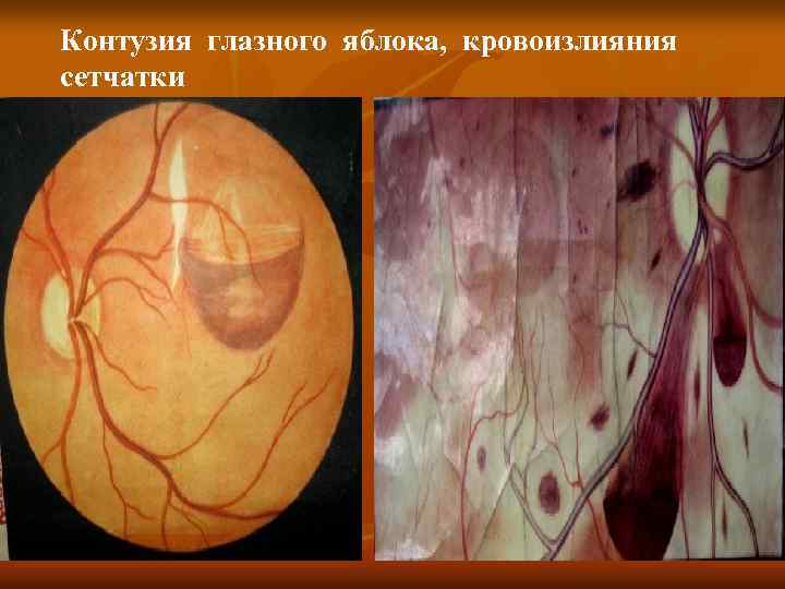 Контузия глазного яблока, кровоизлияния сетчатки 