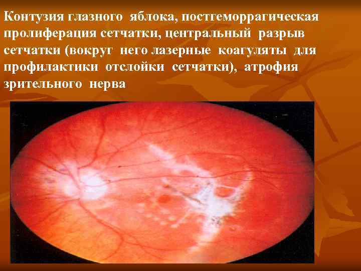 Контузия глазного яблока, постгеморрагическая пролиферация сетчатки, центральный разрыв сетчатки (вокруг него лазерные коагуляты для