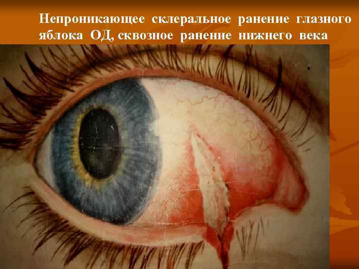 Непроникающее склеральное ранение глазного яблока ОД, сквозное ранение нижнего века 