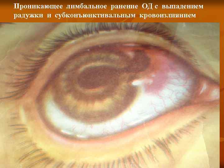 Проникающее лимбальное ранение ОД с выпадением радужки и субконъюнктивальным кровоизлиянием 