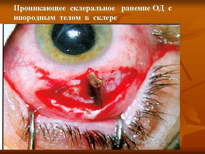Проникающее склеральное ранение ОД с инородным телом в склере 