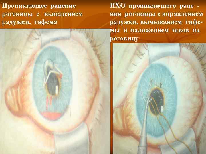 Проникающее ранение роговицы с выпадением радужки, гифема ПХО проникающего ране ния роговицы с вправлением