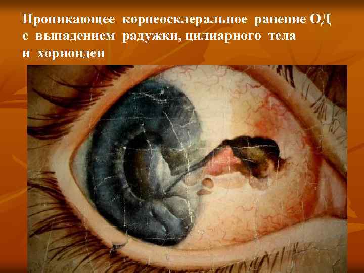 Проникающее корнеосклеральное ранение ОД с выпадением радужки, цилиарного тела и хориоидеи 