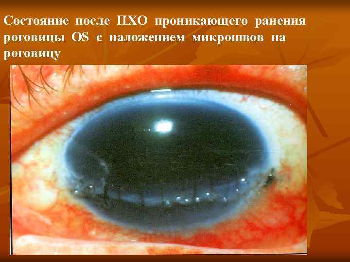 Состояние после ПХО проникающего ранения роговицы OS с наложением микрошвов на роговицу 