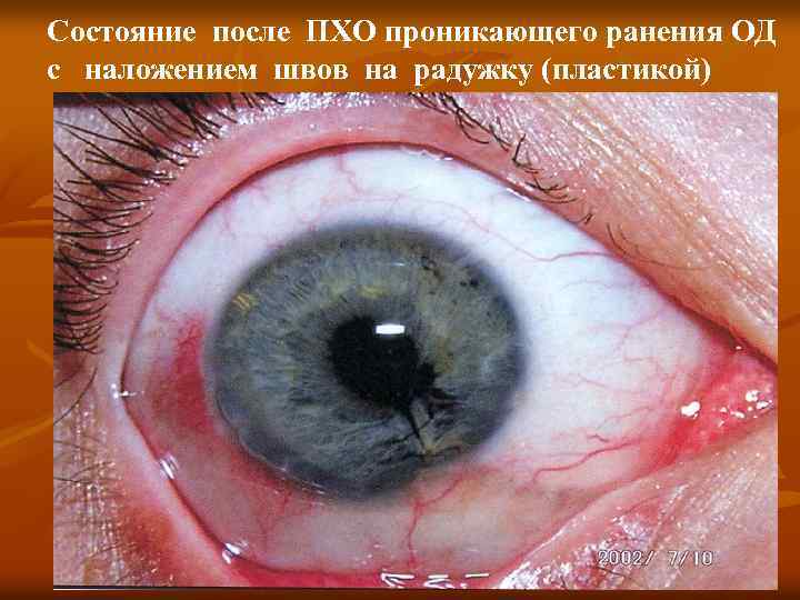 Состояние после ПХО проникающего ранения ОД с наложением швов на радужку (пластикой) 