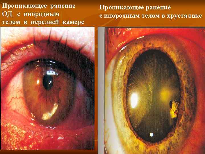 Проникающее ранение ОД с инородным телом в передней камере Проникающее ранение с инородным телом