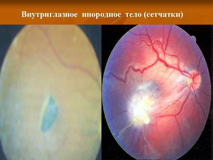 Внутриглазное инородное тело (сетчатки) 