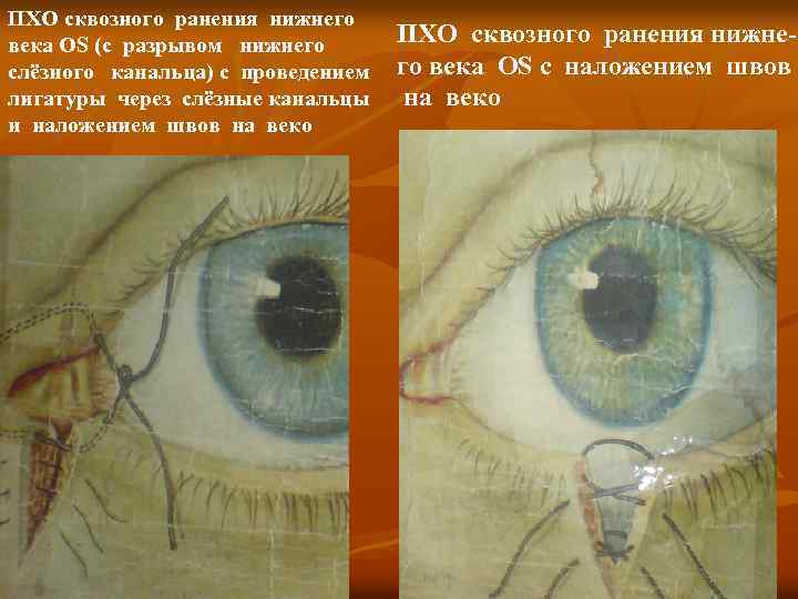 ПХО сквозного ранения нижнего века OS (с разрывом нижнего слёзного канальца) с проведением лигатуры