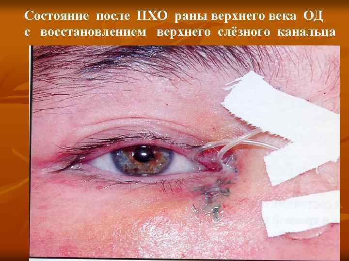 Состояние после ПХО раны верхнего века ОД с восстановлением верхнего слёзного канальца 