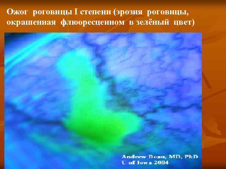 Ожог роговицы I степени (эрозия роговицы, окрашенная флюоресцеином в зелёный цвет) 