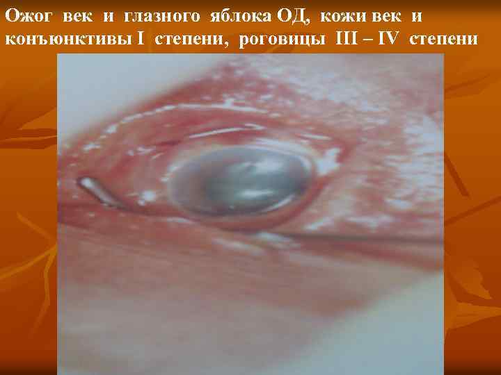 Ожог век и глазного яблока ОД, кожи век и конъюнктивы I степени, роговицы III