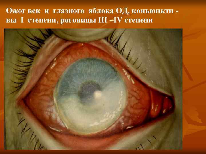 Ожог век и глазного яблока ОД, конъюнкти вы I степени, роговицы III –IV степени