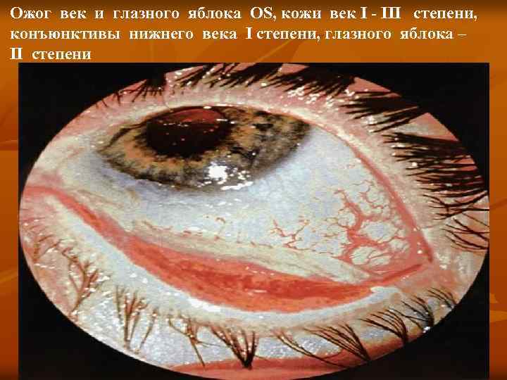 Ожог век и глазного яблока OS, кожи век I - III степени, конъюнктивы нижнего