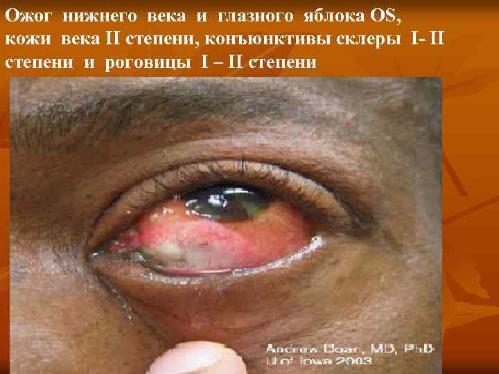 Ожог нижнего века и глазного яблока OS, кожи века II степени, конъюнктивы склеры I-