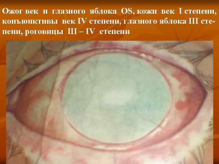 Ожог век и глазного яблока OS, кожи век I степени, конъюнктивы век IV степени,