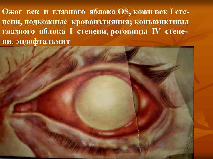 Ожог век и глазного яблока OS, кожи век I степени, подкожные кровоизлияния; конъюнктивы глазного