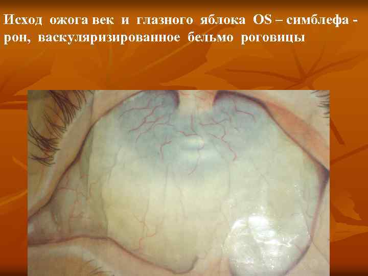 Исход ожога век и глазного яблока OS – симблефа рон, васкуляризированное бельмо роговицы 