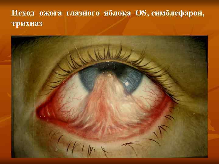 Исход ожога глазного яблока OS, симблефарон, трихиаз 