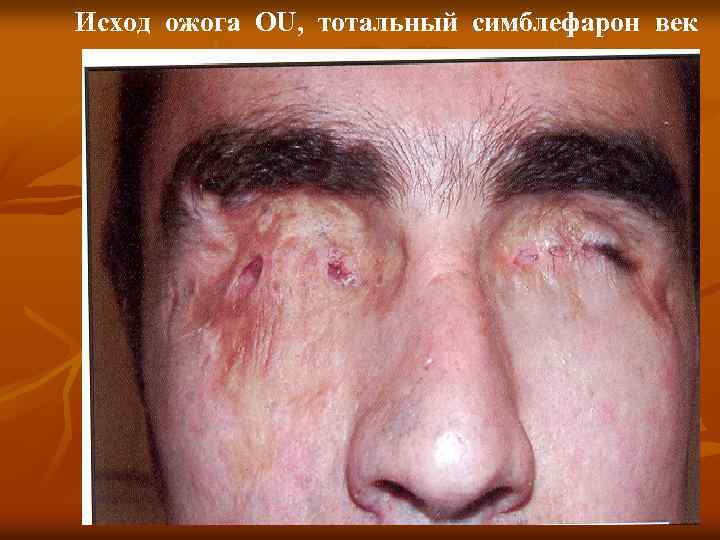 Исход ожога OU, тотальный симблефарон век 