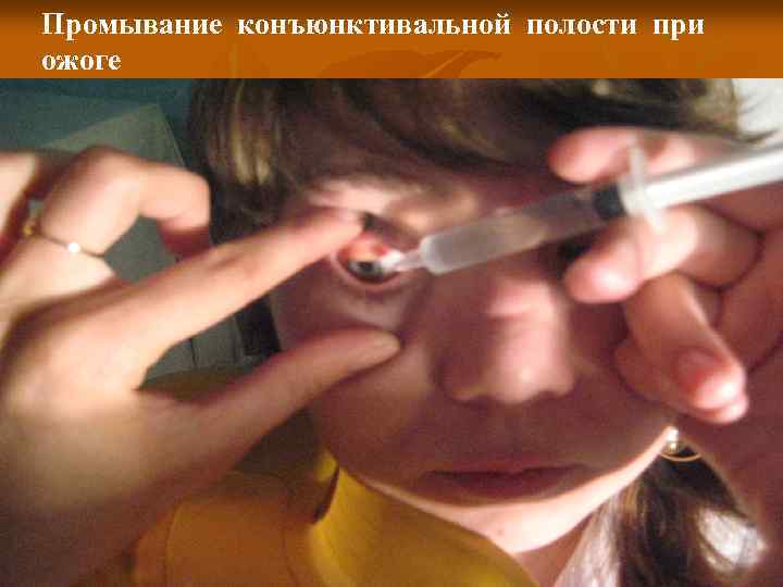 Промывание конъюнктивальной полости при ожоге 