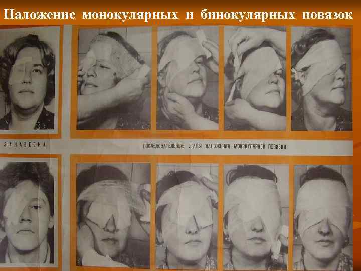 Наложение монокулярных и бинокулярных повязок 