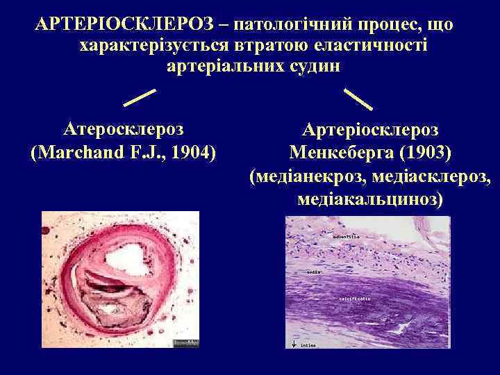 АРТЕРІОСКЛЕРОЗ – патологічний процес, що характерізується втратою еластичності артеріальних судин Атеросклероз (Marchand F. J.