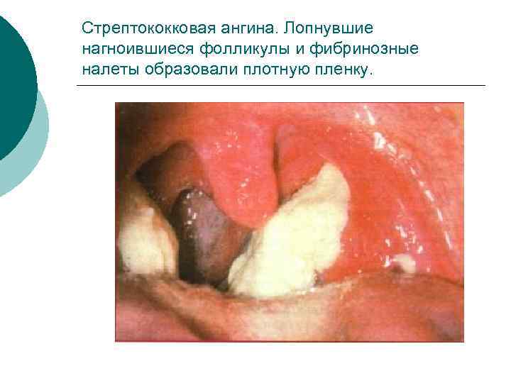 Стрептококковая ангина. Лопнувшие нагноившиеся фолликулы и фибринозные налеты образовали плотную пленку. 