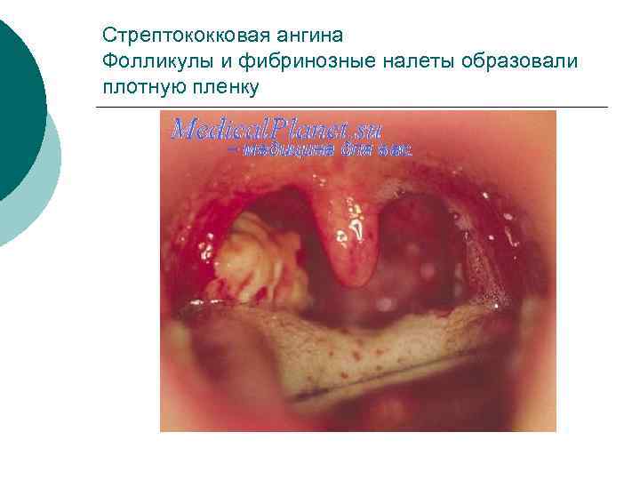 Стрептококковая ангина Фолликулы и фибринозные налеты образовали плотную пленку 