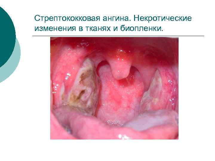 Стрептококковая ангина. Некротические изменения в тканях и биопленки. 