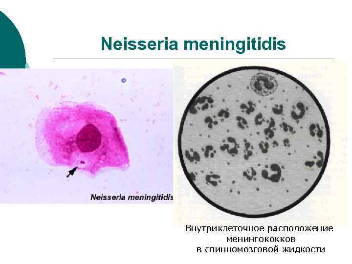Neisseria meningitidis Внутриклеточное расположение менингококков в спинномозговой жидкости 