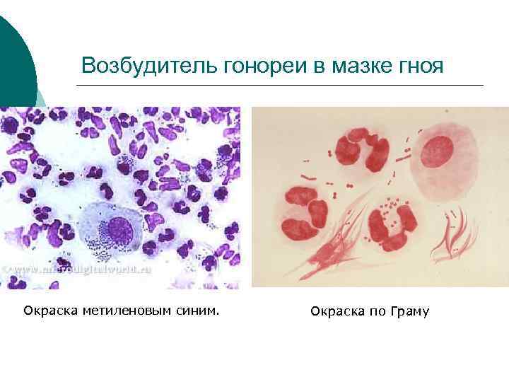 Возбудитель гонореи в мазке гноя Окраска метиленовым синим. Окраска по Граму 