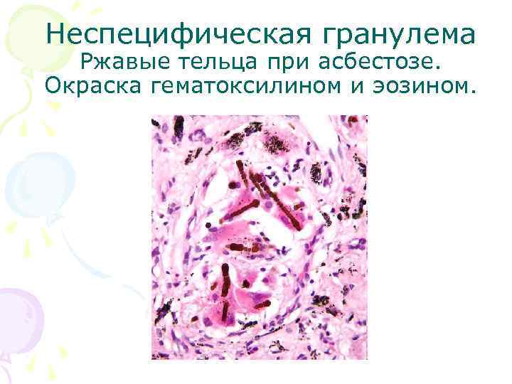 Неспецифическая гранулема Ржавые тельца при асбестозе. Окраска гематоксилином и эозином. 