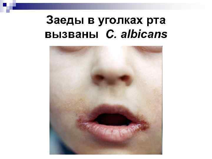 Заеды в уголках рта вызваны C. albicans 
