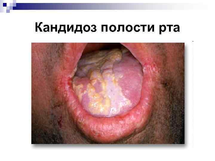 Кандидоз полости рта 