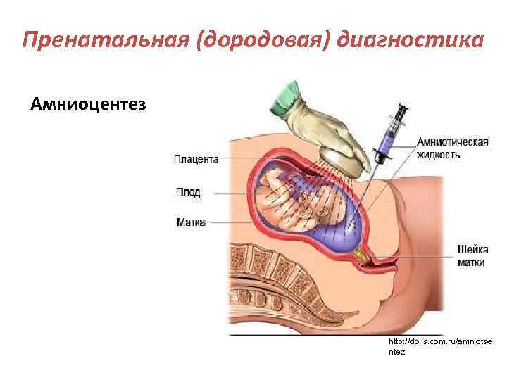Пренатальная (дородовая) диагностика Амниоцентез http: //dolis. com. ru/amniotse ntez 