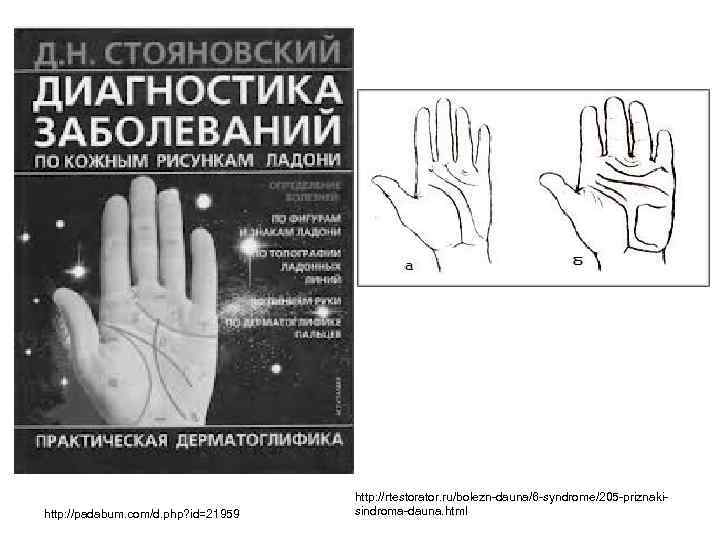 http: //padabum. com/d. php? id=21959 http: //rtestorator. ru/bolezn-dauna/6 -syndrome/205 -priznakisindroma-dauna. html 