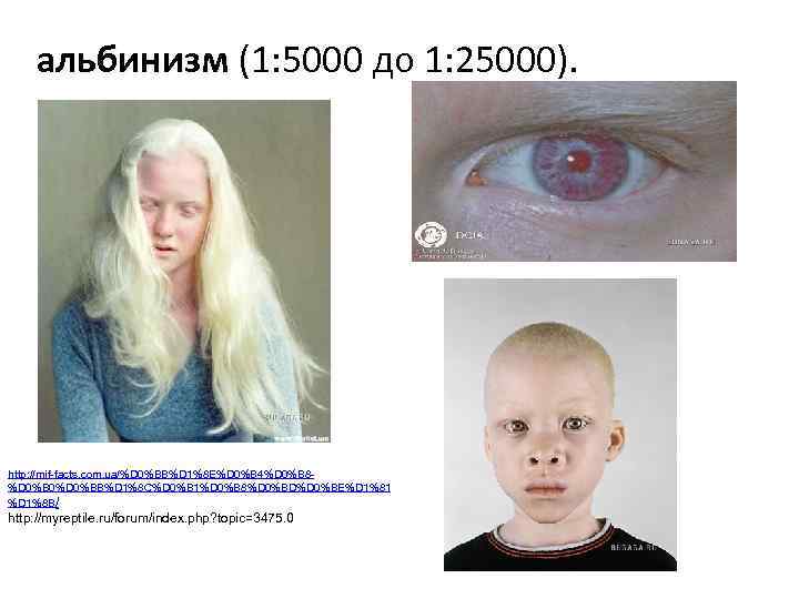 альбинизм (1: 5000 до 1: 25000). альбинизм http: //mif-facts. com. ua/%D 0%BB%D 1%8 E%D