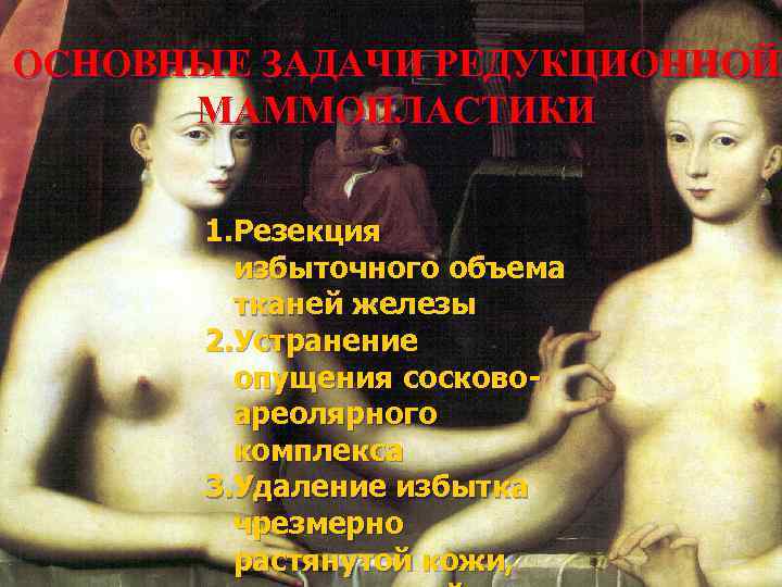 ОСНОВНЫЕ ЗАДАЧИ РЕДУКЦИОННОЙ МАММОПЛАСТИКИ 1. Резекция избыточного объема тканей железы 2. Устранение опущения сосковоареолярного
