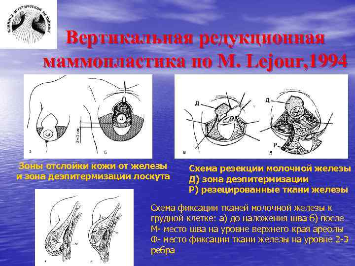 Редукционная маммопластика