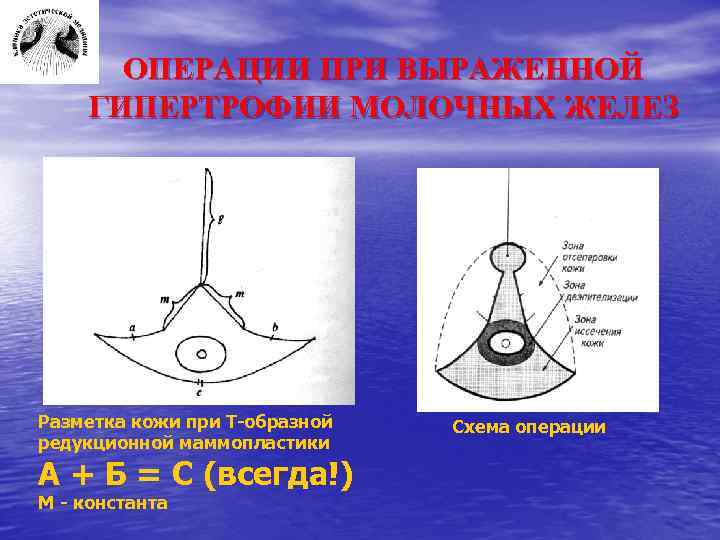 ОПЕРАЦИИ ПРИ ВЫРАЖЕННОЙ ГИПЕРТРОФИИ МОЛОЧНЫХ ЖЕЛЕЗ Разметка кожи при Т-образной редукционной маммопластики А +
