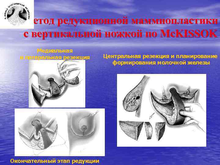 Метод редукционной маммиопластики с вертикальной ножкой по Mc. KISSOK Медиальная и латеральная резекция Окончательный